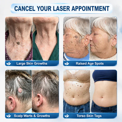 FDA Registered Facility|𝟕-𝐃𝒂𝘆 𝐒𝗸𝐢𝐧 𝐓𝒂𝗴 & 𝐒𝐩𝙤𝐭 𝐄𝐫𝒂𝐬𝙚𝐫 Painless & Scar-Free Advanced Imperfection Removal Rollerball Pen